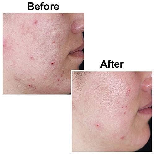 Kojic Acid Soap 135G